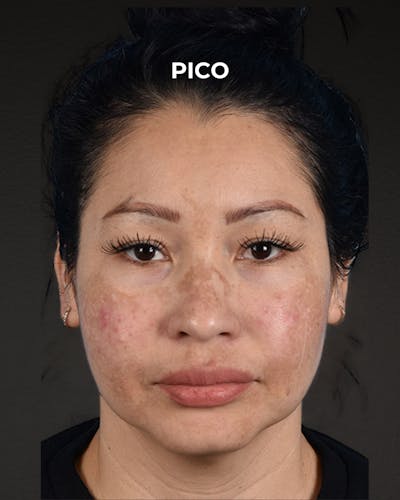 Pigment Laser Before & After Gallery - Patient 555927 - Image 1