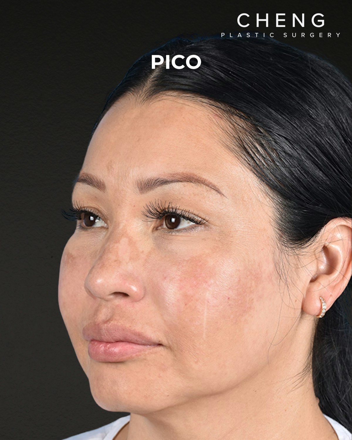 Pigment Laser Before & After Gallery - Patient 555927 - Image 6
