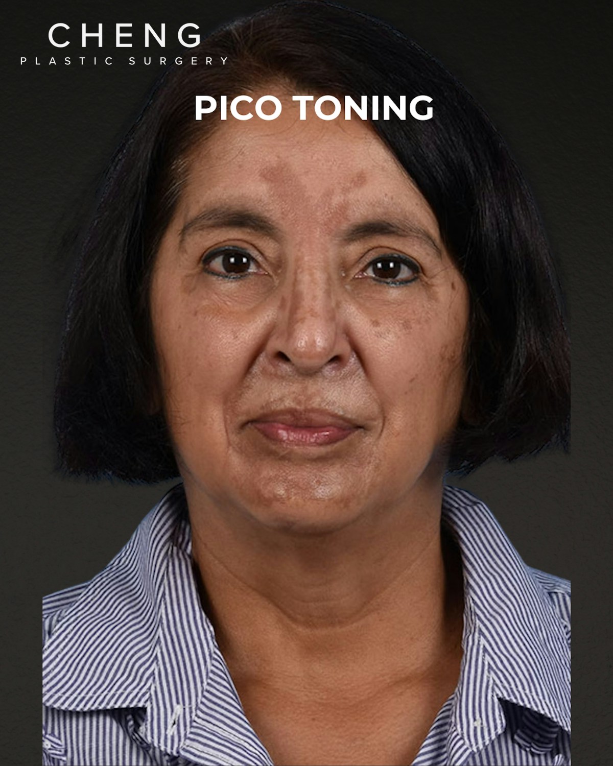 Pigment Laser Before & After Gallery - Patient 210761 - Image 1