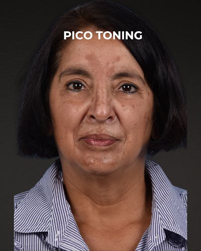 Pigment Laser Before & After Gallery - Patient 210761 - Image 1