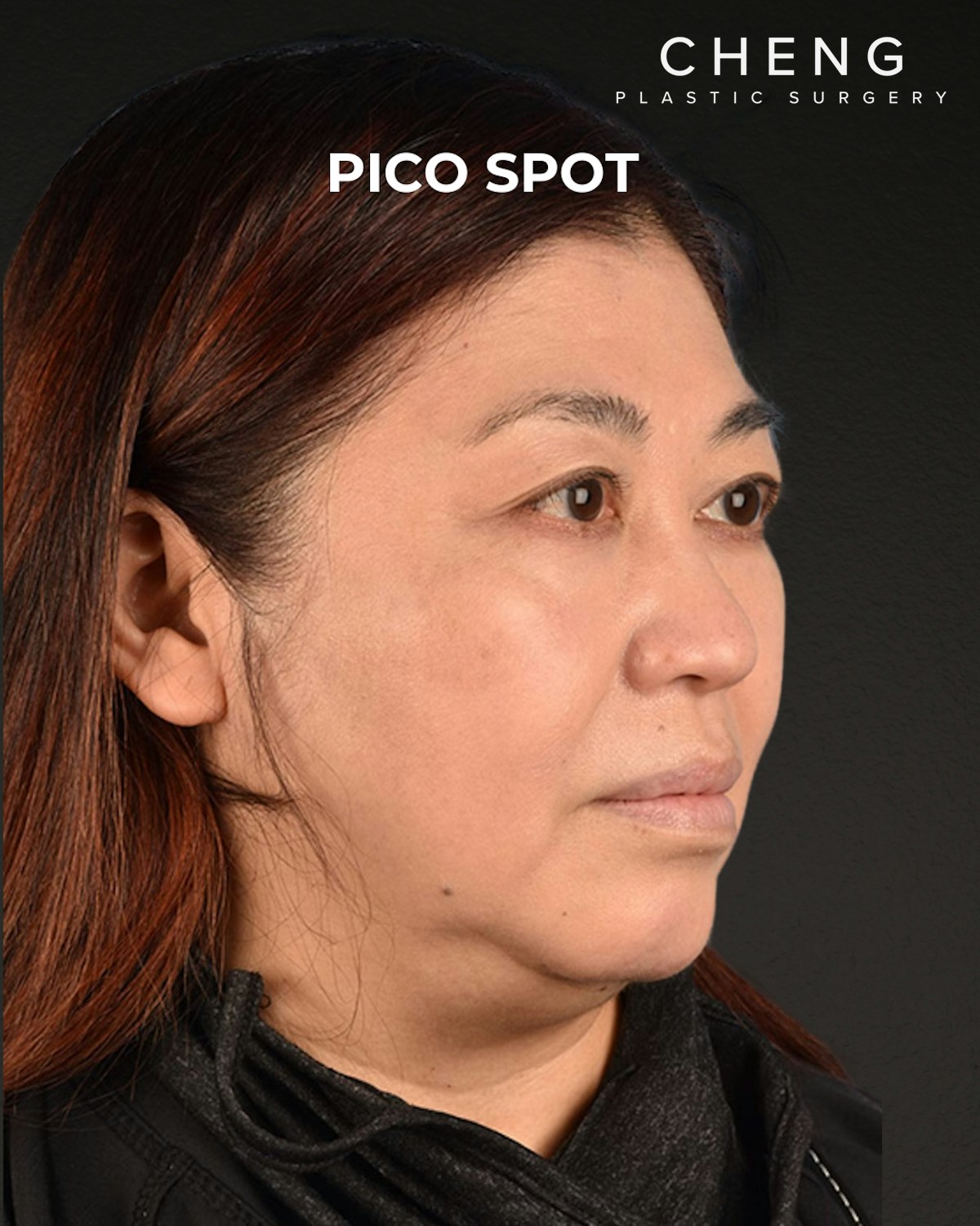 Pigment Laser Before & After Gallery - Patient 332305 - Image 6