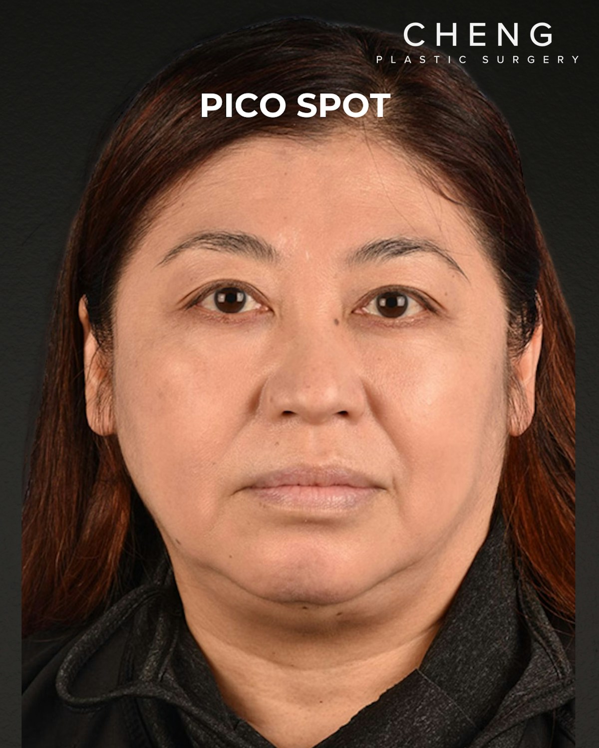 Pigment Laser Before & After Gallery - Patient 332305 - Image 2