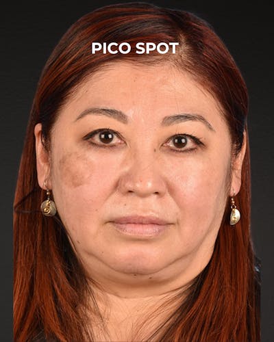 Pigment Laser Before & After Gallery - Patient 332305 - Image 1