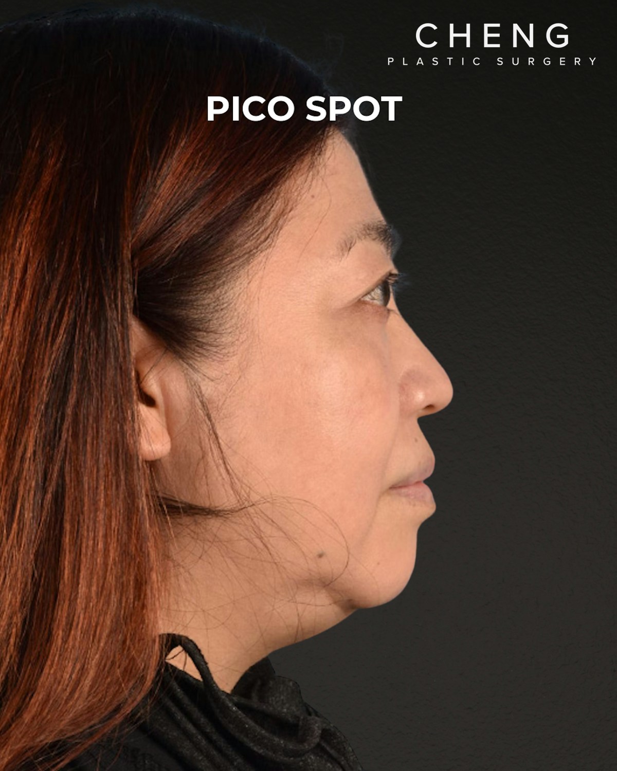 Pigment Laser Before & After Gallery - Patient 332305 - Image 4