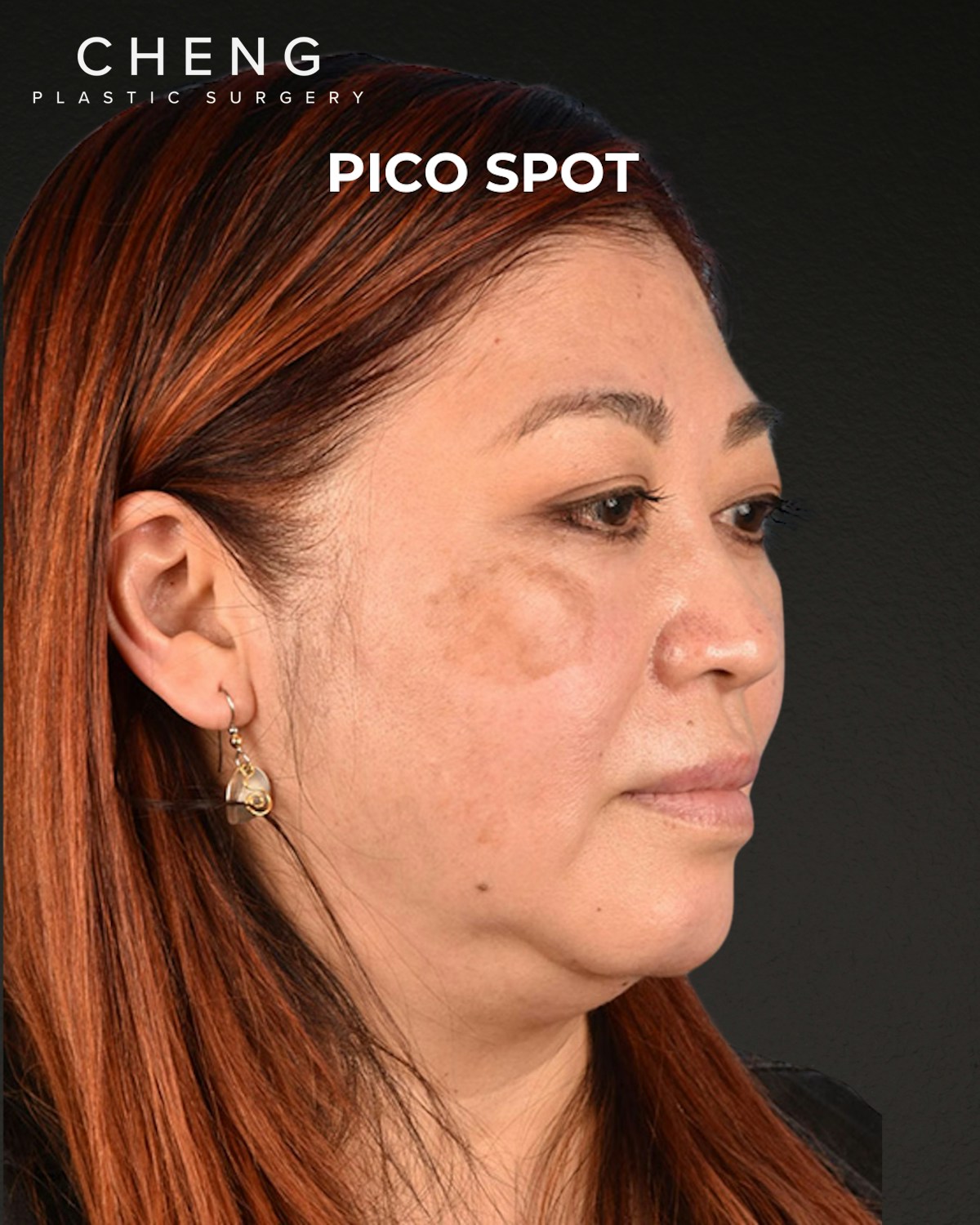 Pigment Laser Before & After Gallery - Patient 332305 - Image 5
