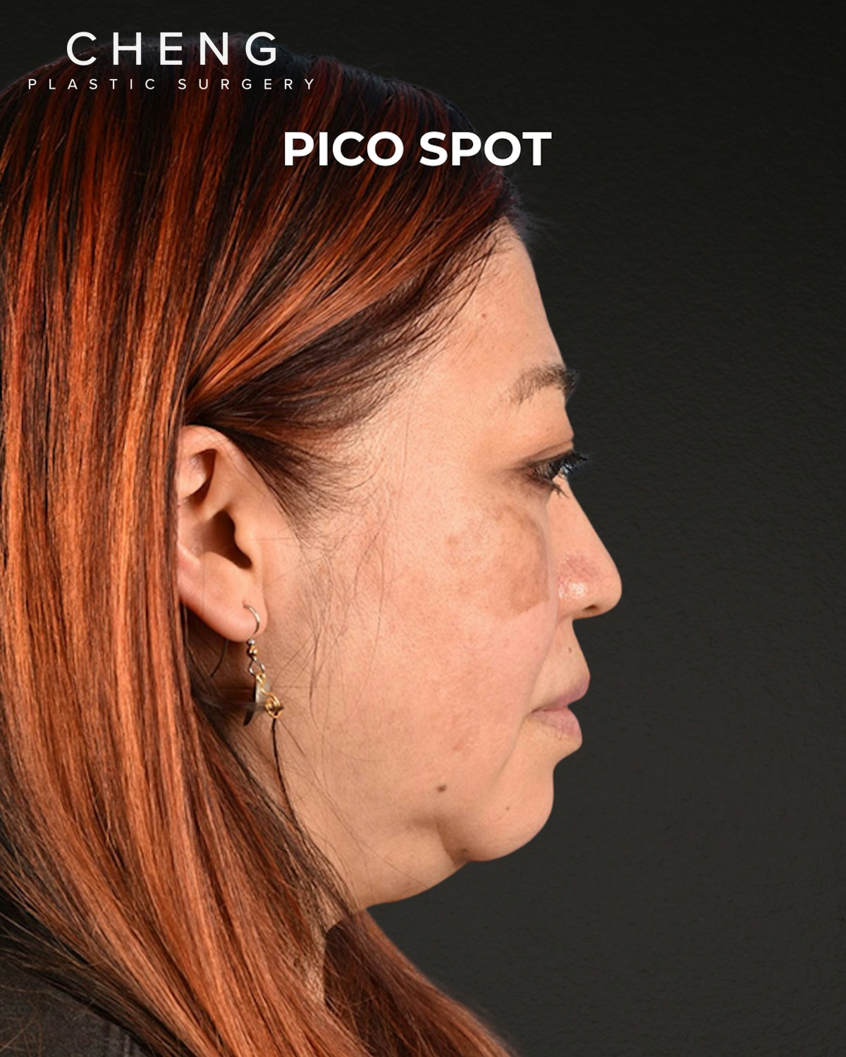 Pigment Laser Before & After Gallery - Patient 332305 - Image 3