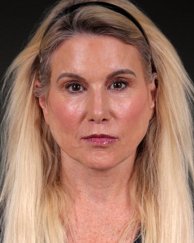Co2 Laser Before & After Gallery - Patient 294526 - Image 2