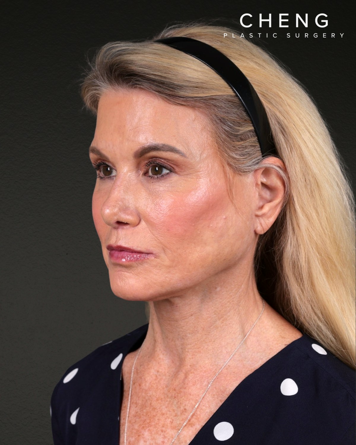 Facelift Before & After Gallery - Patient 105916 - Image 8