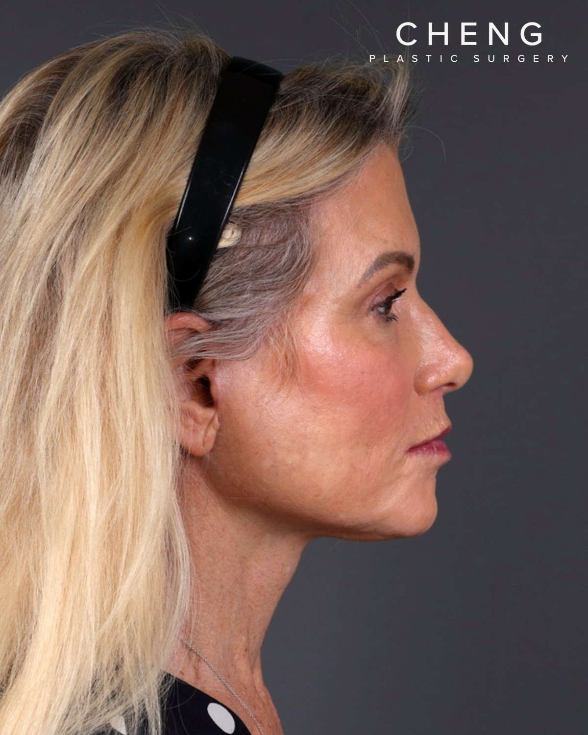 Facelift Before & After Gallery - Patient 105916 - Image 6