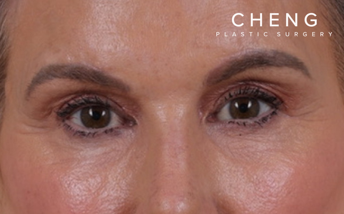 Blepharoplasty Before & After Gallery - Patient 855329 - Image 2