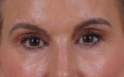 Brow Lift Before & After Gallery - Patient 320616 - Image 2