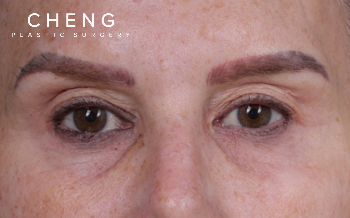 Blepharoplasty Before & After Gallery - Patient 855329 - Image 1