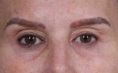 Brow Lift Before & After Gallery - Patient 320616 - Image 1