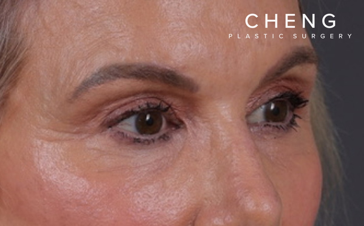 Blepharoplasty Before & After Gallery - Patient 855329 - Image 4
