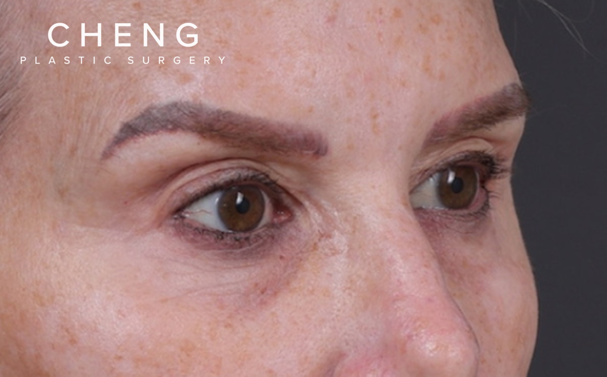 Blepharoplasty Before & After Gallery - Patient 855329 - Image 3