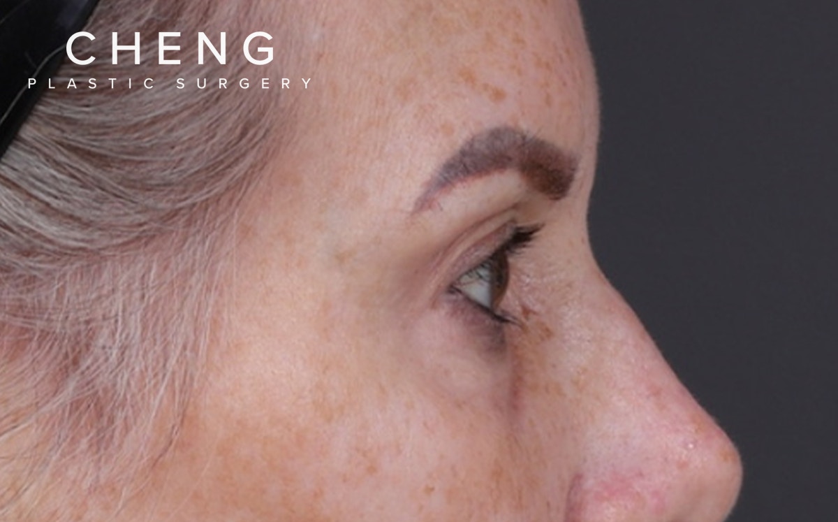 Blepharoplasty Before & After Gallery - Patient 855329 - Image 5