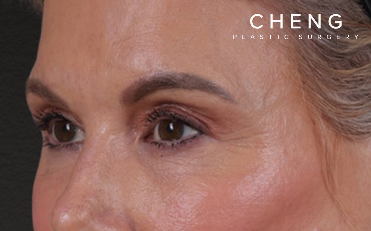 Blepharoplasty Before & After Gallery - Patient 855329 - Image 8