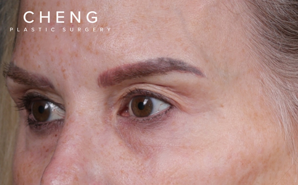 Blepharoplasty Before & After Gallery - Patient 855329 - Image 7