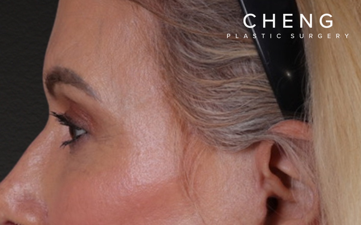 Blepharoplasty Before & After Gallery - Patient 855329 - Image 10