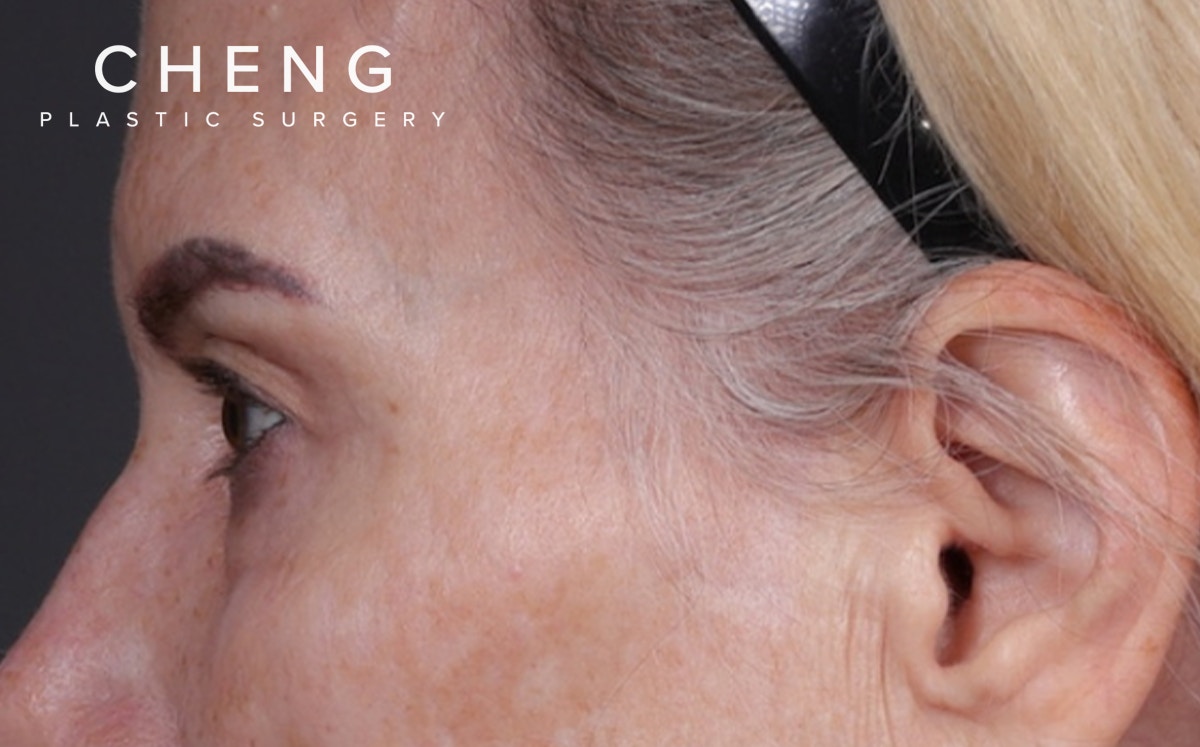 Blepharoplasty Before & After Gallery - Patient 855329 - Image 9