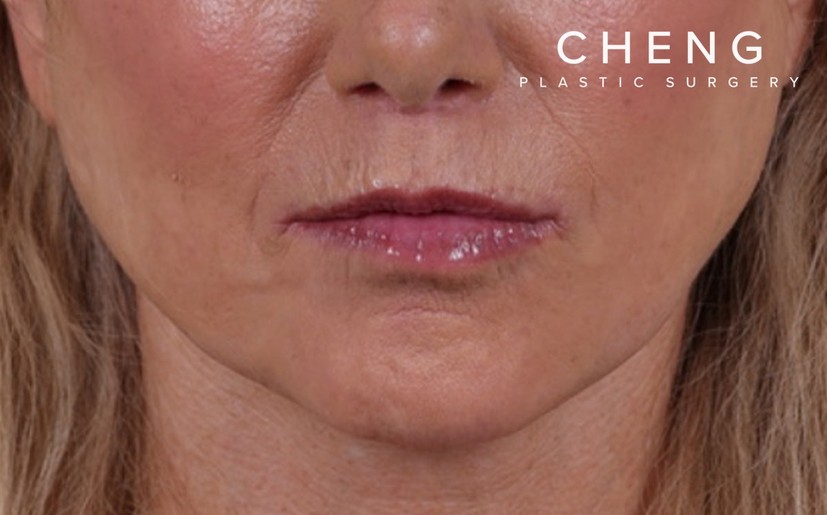 Lip Lift Before & After Gallery - Patient 232096 - Image 2