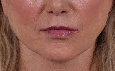 Lip Lift Before & After Gallery - Patient 232096 - Image 2