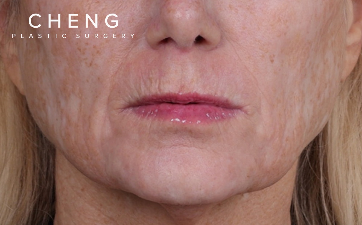 Lip Lift Before & After Gallery - Patient 232096 - Image 1