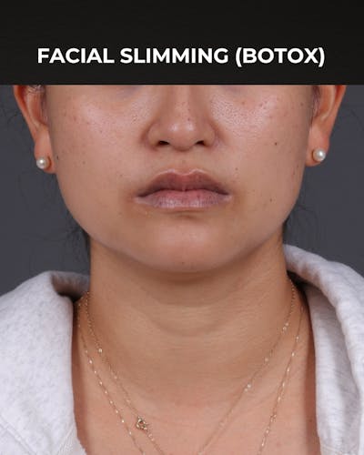 Botox and Dysport Before & After Gallery - Patient 361625 - Image 2
