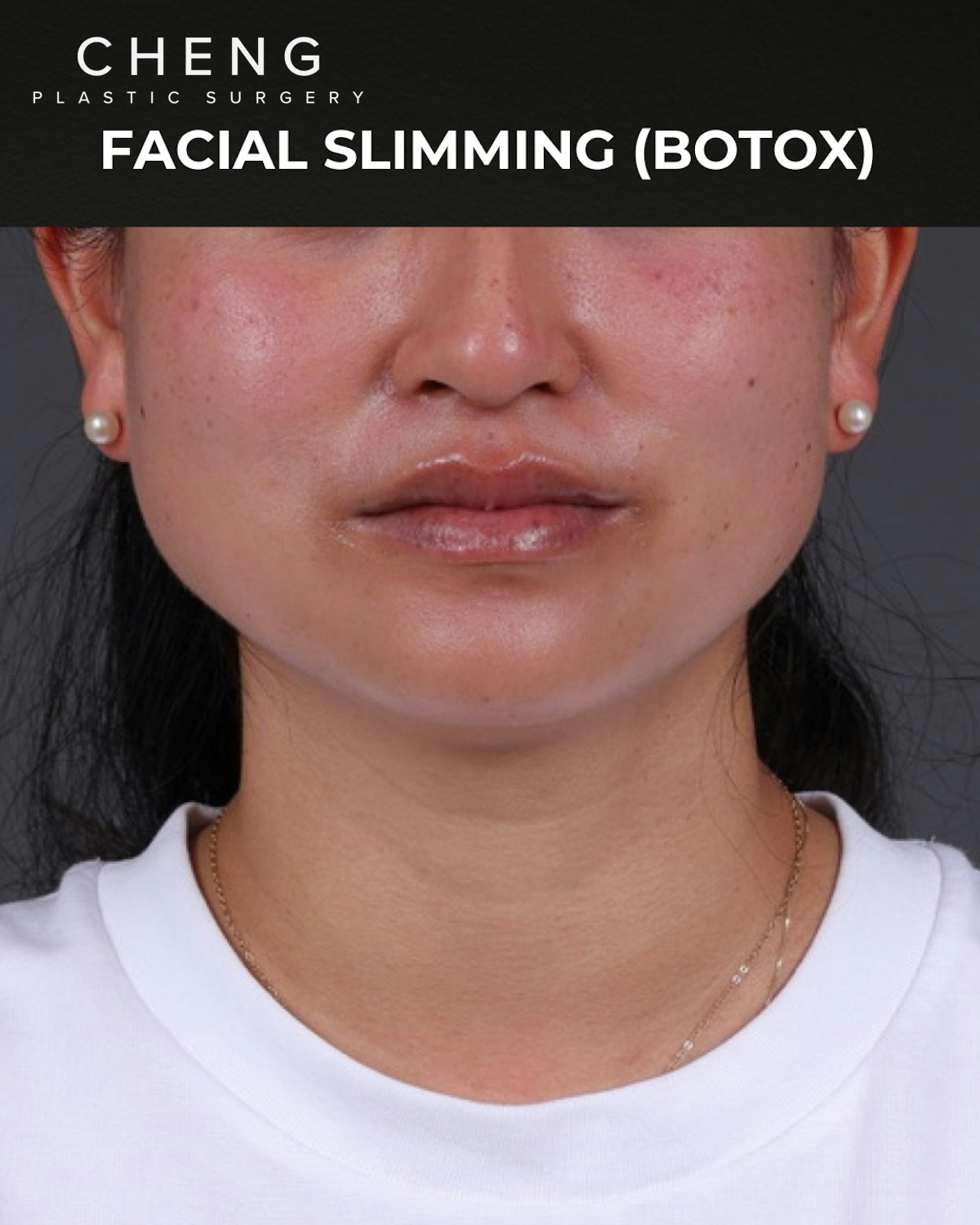 Botox and Dysport Before & After Gallery - Patient 361625 - Image 1