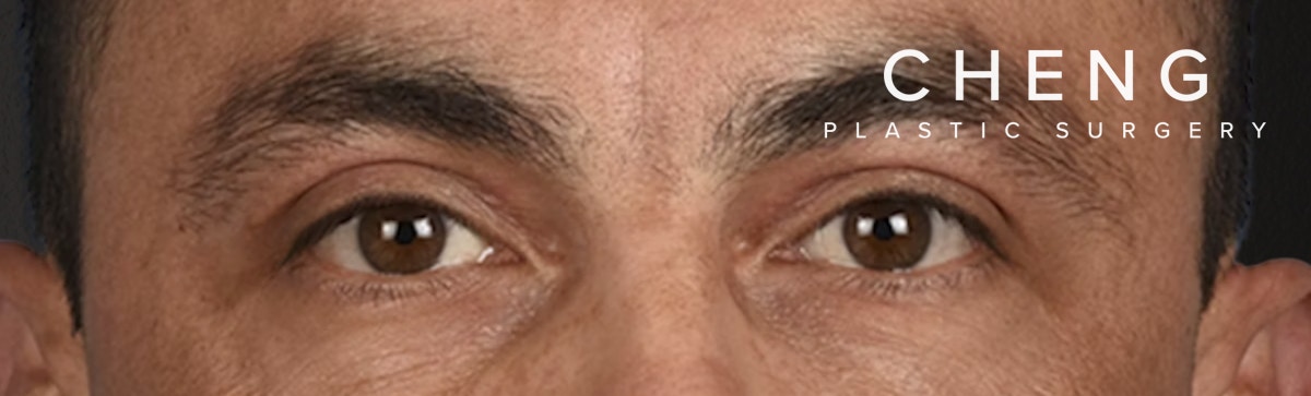 Blepharoplasty Before & After Gallery - Patient 167971 - Image 2