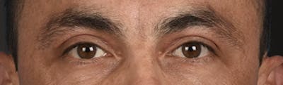 Blepharoplasty Before & After Gallery - Patient 167971 - Image 2