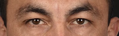 Blepharoplasty Before & After Gallery - Patient 167971 - Image 1