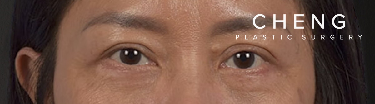Blepharoplasty Before & After Gallery - Patient 284163 - Image 2