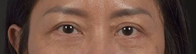 Blepharoplasty Before & After Gallery - Patient 284163 - Image 2