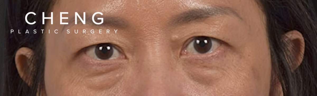 Blepharoplasty Before & After Gallery - Patient 284163 - Image 1