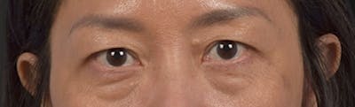 Blepharoplasty Before & After Gallery - Patient 284163 - Image 1