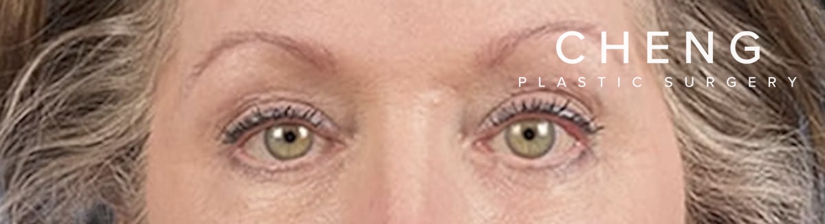Blepharoplasty Before & After Gallery - Patient 362822 - Image 2