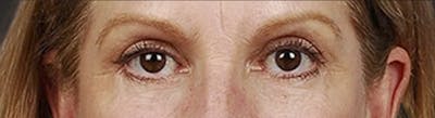 Blepharoplasty Before & After Gallery - Patient 177584 - Image 2