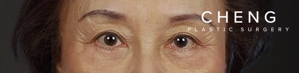 Blepharoplasty Before & After Gallery - Patient 181630 - Image 2