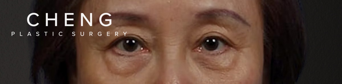 Blepharoplasty Before & After Gallery - Patient 181630 - Image 1