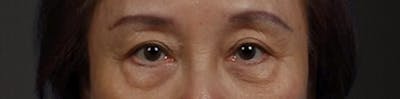 Blepharoplasty Before & After Gallery - Patient 181630 - Image 1