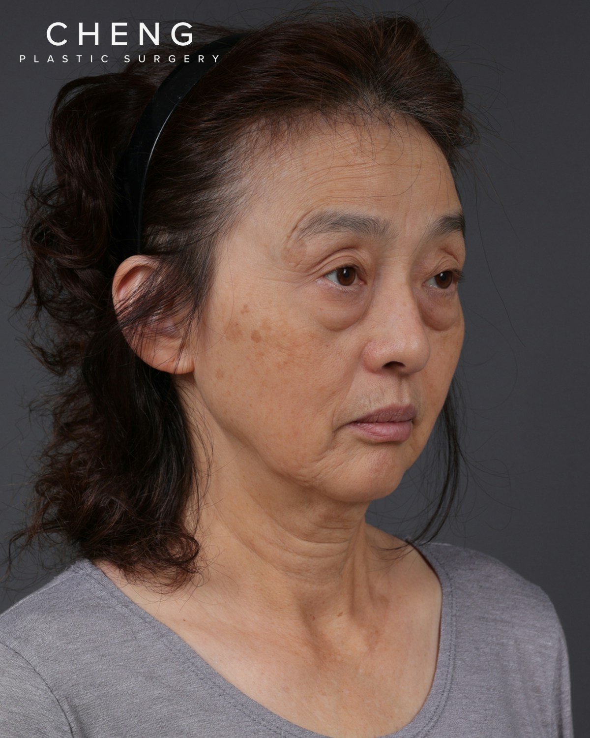 Co2 Laser Before & After Gallery - Patient 377235 - Image 1