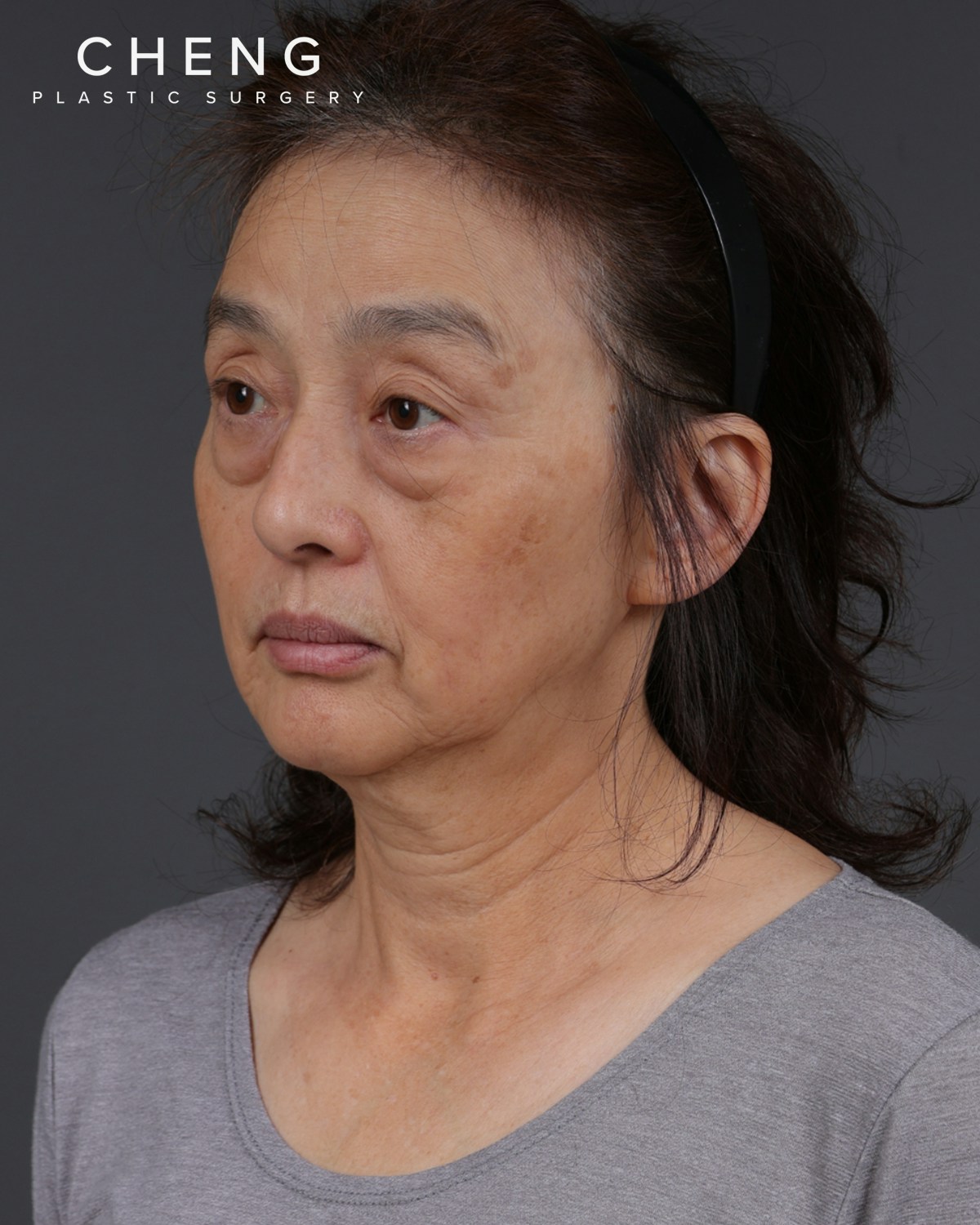 Co2 Laser Before & After Gallery - Patient 377235 - Image 3