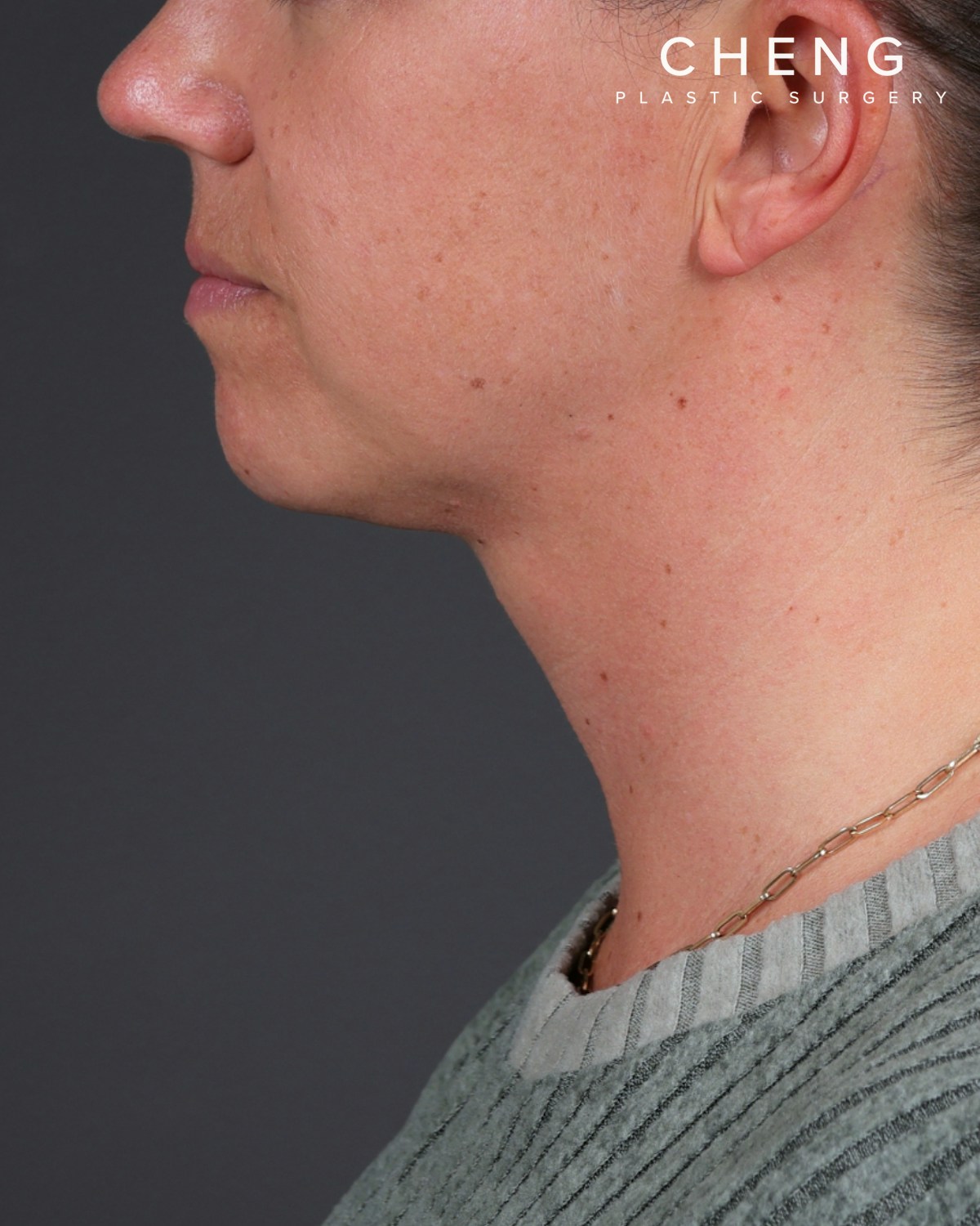 Neck Lift Before & After Gallery - Patient 261911 - Image 4