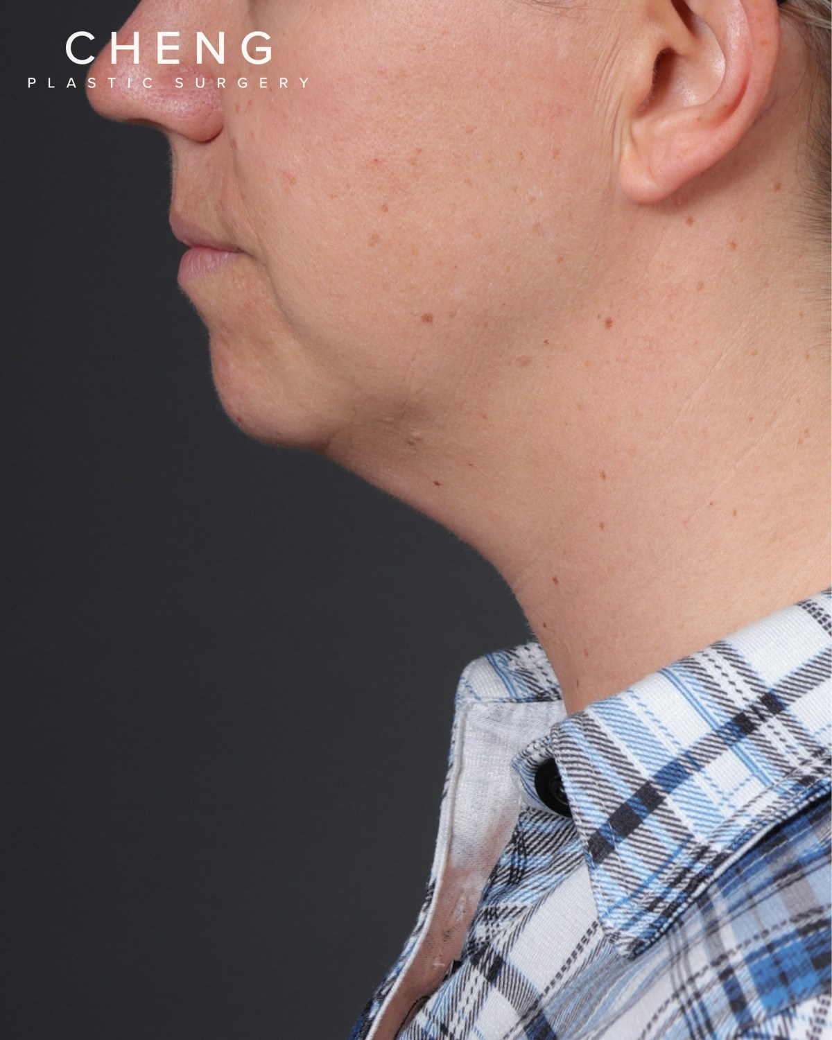 Neck Lift Before & After Gallery - Patient 261911 - Image 3