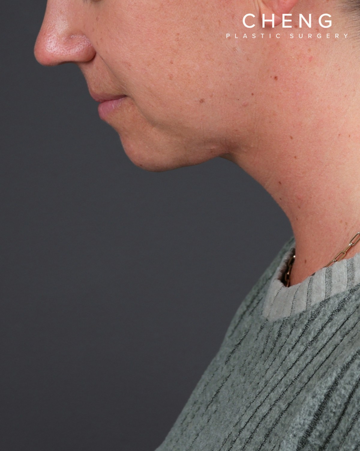 Neck Lift Before & After Gallery - Patient 261911 - Image 2