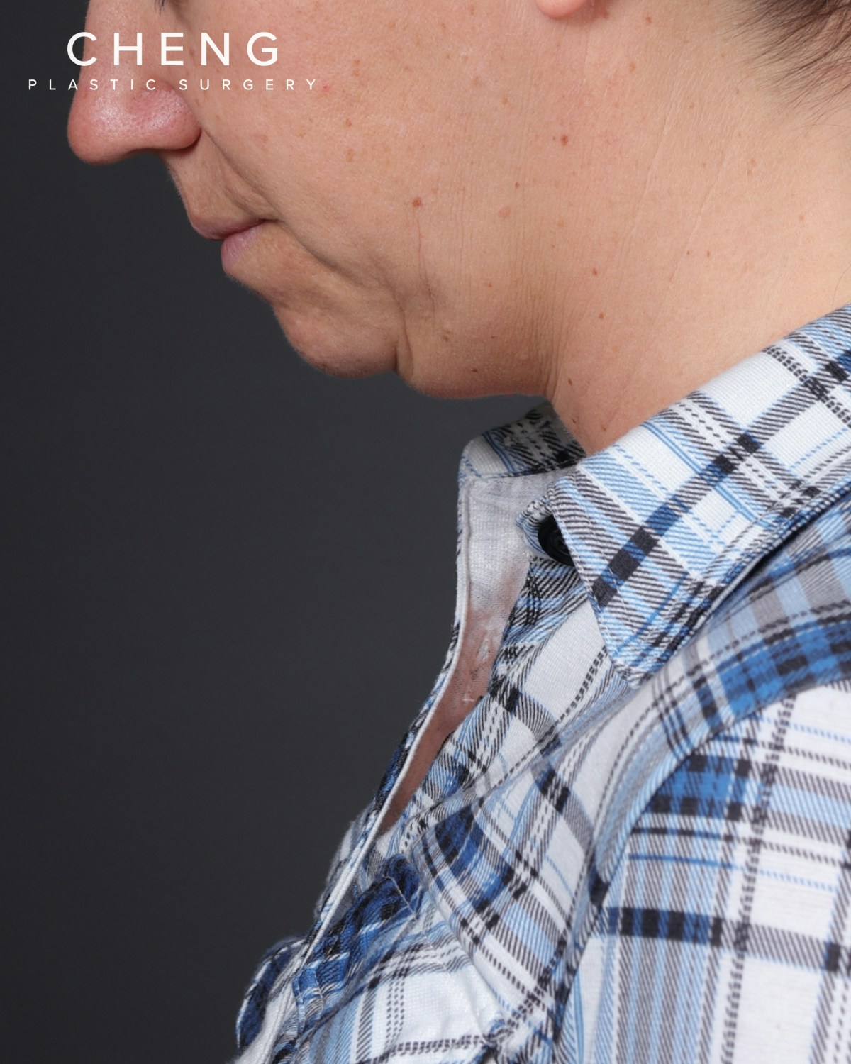 Neck Lift Before & After Gallery - Patient 261911 - Image 1