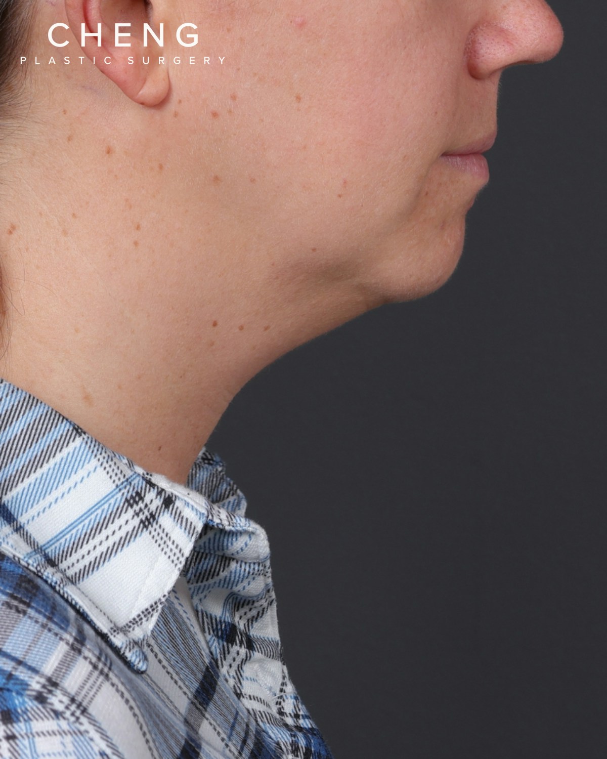 Neck Lift Before & After Gallery - Patient 261911 - Image 7
