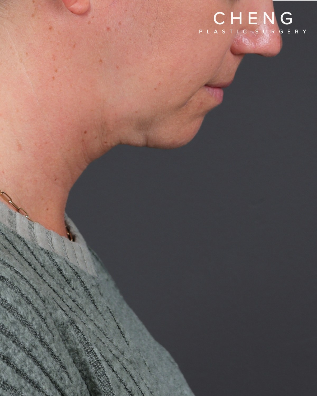 Neck Lift Before & After Gallery - Patient 261911 - Image 6