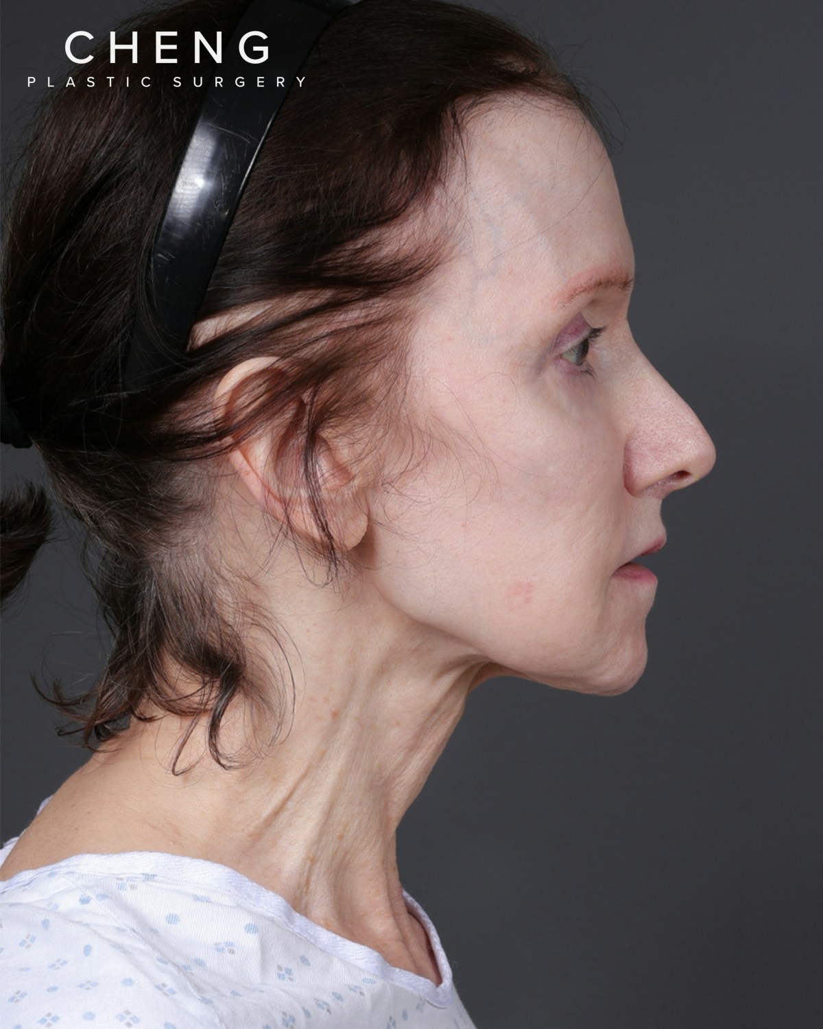 Facelift Before & After Gallery - Patient 681791 - Image 1